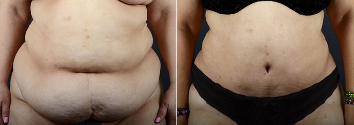 abdominoplasty-liposuction-11977a-sobel