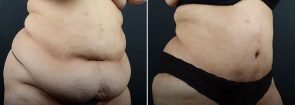 abdominoplasty-liposuction-11977b-sobel