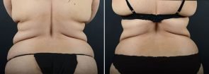 abdominoplasty-liposuction-11977d-sobel