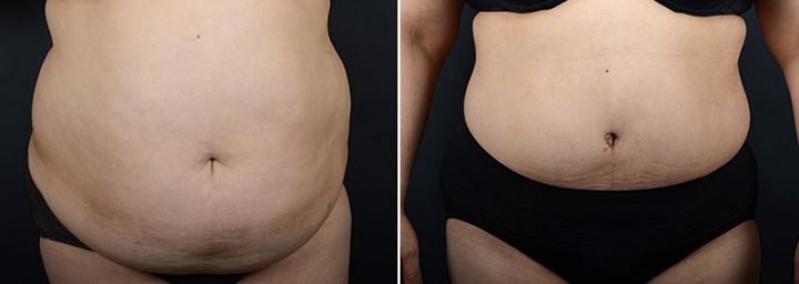 abdominoplasty-liposuction-12006a-sobel