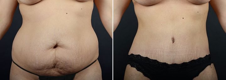 abdominoplasty-liposuction-12064a-sobel