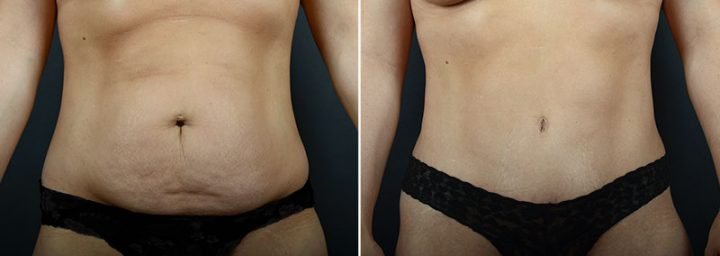 abdominoplasty-liposuction-fat-transfer-12029a-sobel-