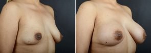 breast-augmentation-12171b-sobel