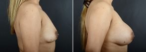 breast-augmentation-12171c-sobel