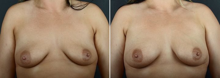 breast-augmentation-fat-transfer-12029a-sobel