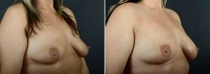 breast-augmentation-fat-transfer-12029b-sobel
