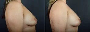 breast-augmentation-fat-transfer-12029c-sobel