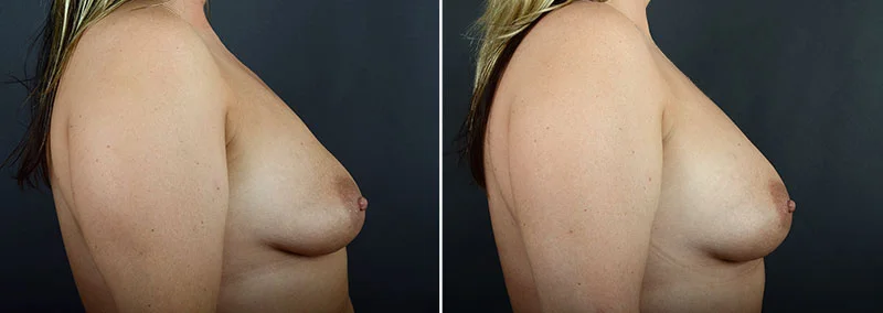 breast-augmentation-fat-transfer-12029c-sobel