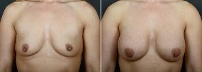 Breast Lift with Augmentation