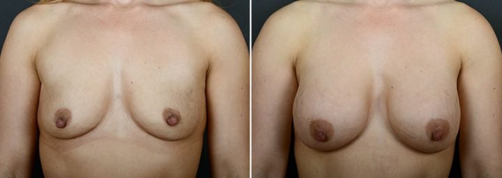 breast-lift-with-implants-12183a-sobel