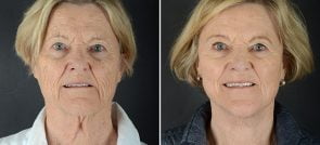 facelift-necklift-12238a-sobel