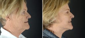 facelift-necklift-12238c-sobel