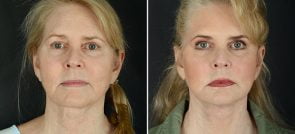 facelift-necklift-eyelids-browlift-11990a-sobel