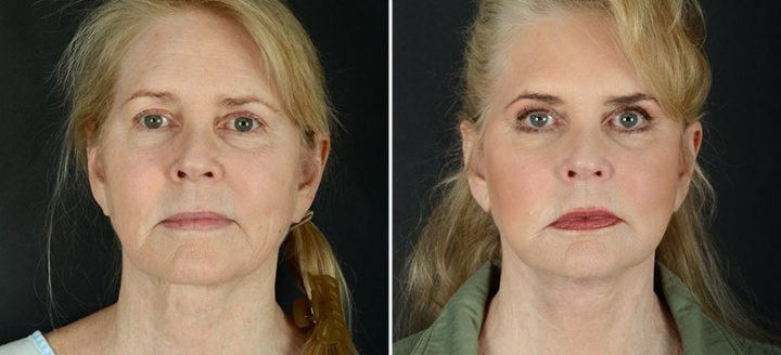 facelift-necklift-eyelids-browlift-11990a-sobel