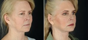 facelift-necklift-eyelids-browlift-11990b-sobel