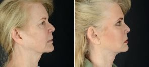 facelift-necklift-eyelids-browlift-11990c-sobel