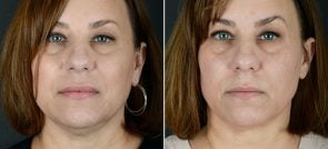 injectable-fillers-kybella-11966a-sobel