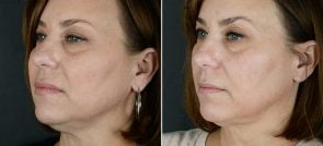 injectable-fillers-kybella-11966b-sobel