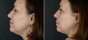 injectable-fillers-kybella-11966c-sobel