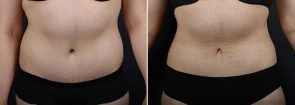 liposuction-fat-transfer-12133a-sobel