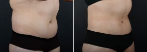 liposuction-fat-transfer-12133b-sobel