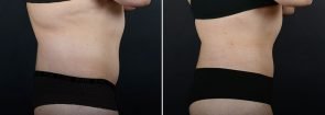 liposuction-fat-transfer-12133c-sobel