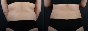 liposuction-fat-transfer-12133d-sobel