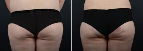 Fat Transfer to Buttocks