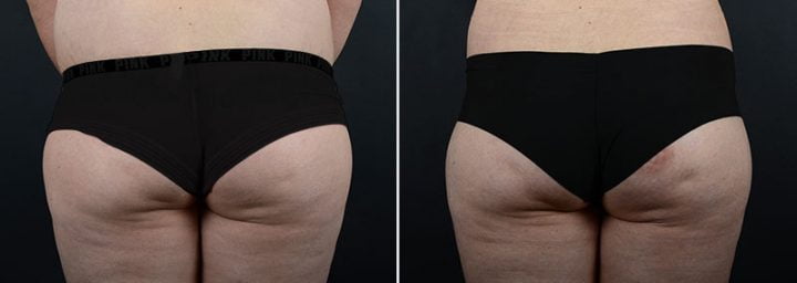 liposuction-fat-transfer-12133d2-sobel