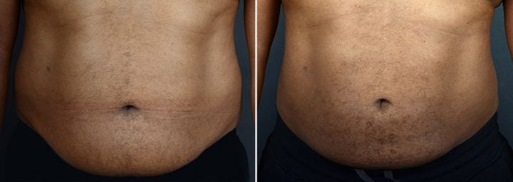liposuction-male-12212a-sobel