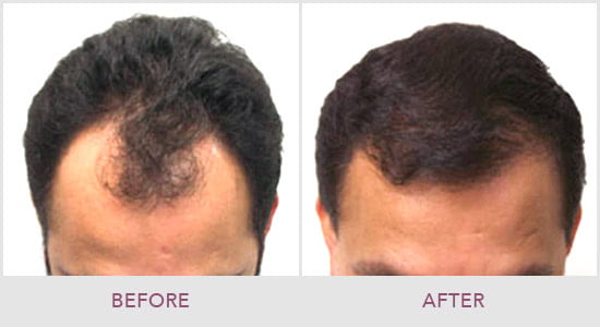 Seattle Hair Restoration | Anderson Sobel Cosmetic Surgery