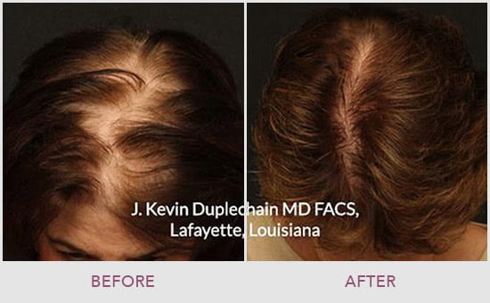 Seattle Hair Restoration | Anderson Sobel Cosmetic Surgery Seattle Hair Restoration | Anderson Sobel Cosmetic Surgery