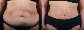 Tummy Tuck with Liposuction