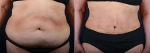 abdominoplasty-14613a-sobel