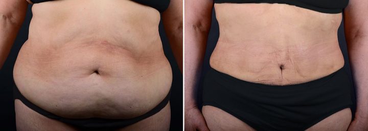 abdominoplasty-14613a-sobel