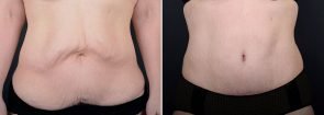 Tummy Tuck with Liposuction