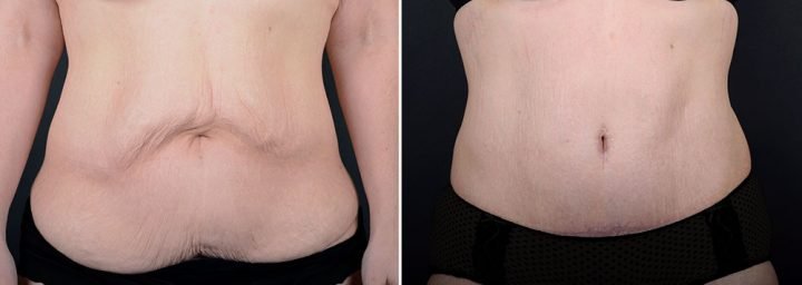 abdominoplasty-liposuction-14702a-sobel