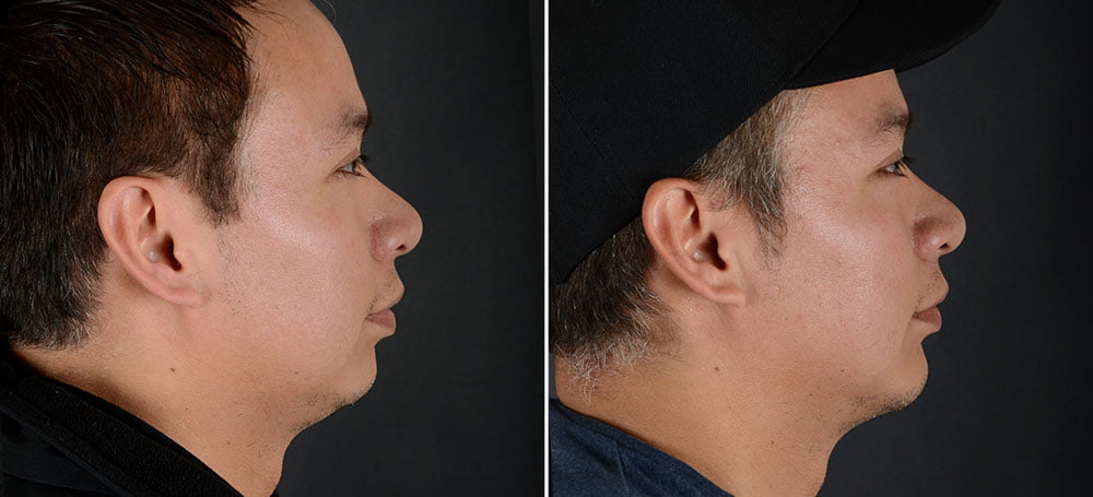 Male patient before and after chin enhancement with Dr. Sobel