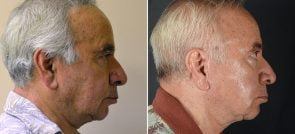 facelift-male-14677c-sobel