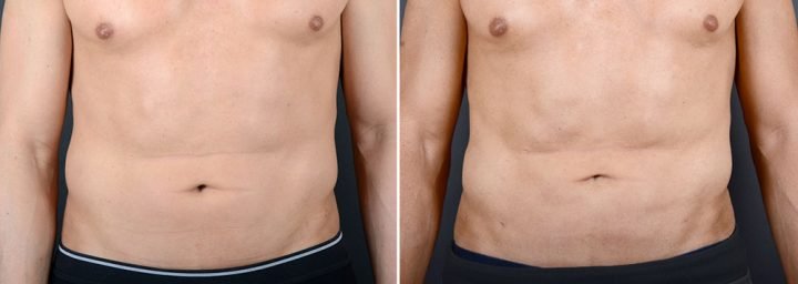 liposuction-male-14637a-sobel
