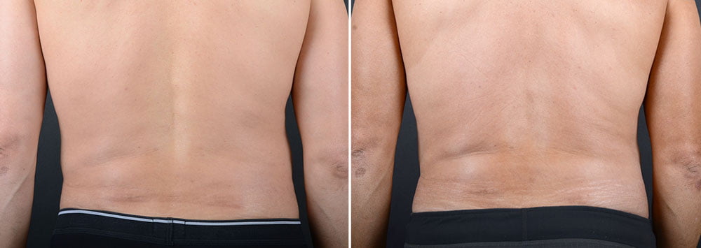 Before and after liposuction on a male patient of Dr. Sobel