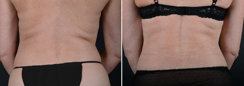 Upper body liposuction