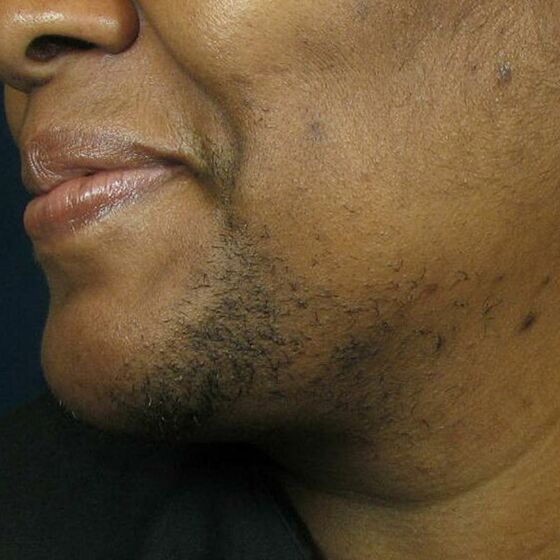 laser hair removal near me black skin