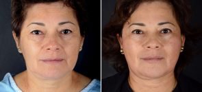 Facelift, Eyelid Lift, & Brow Lift