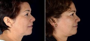 facelift-eyelid-brow-lift-16689c-sobel