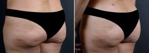 fat-transfer-buttocks-16737b-sobel