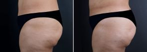 fat-transfer-buttocks-16737c-sobel