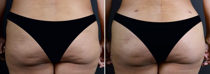 fat-transfer-buttocks-16737d-sobel