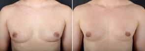 Male Chest Reduction