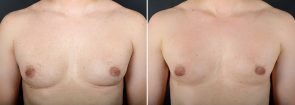 gynecomastia-16704a-sobel